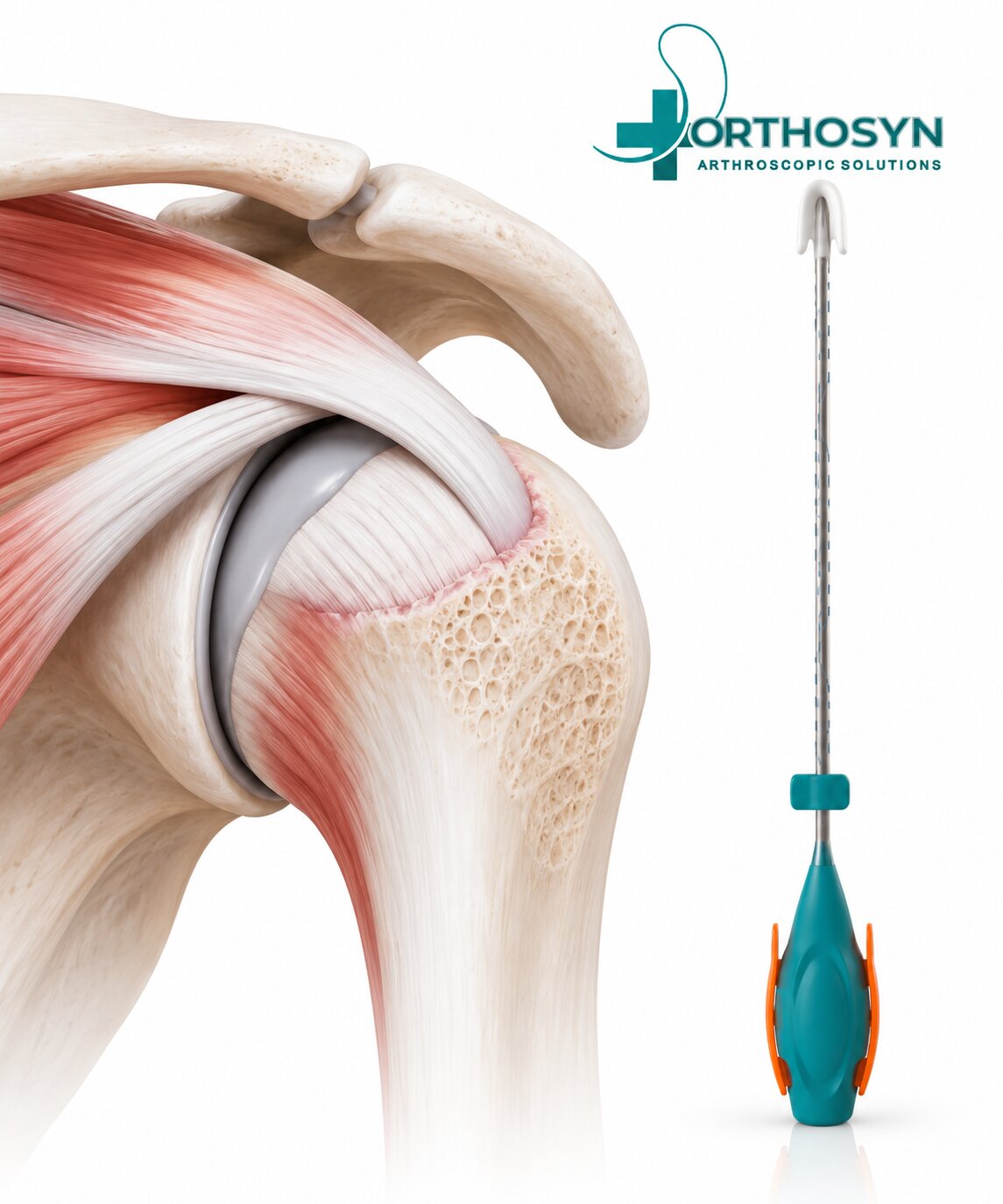 what-is-remplissage-and-how-are-suture-anchors-used