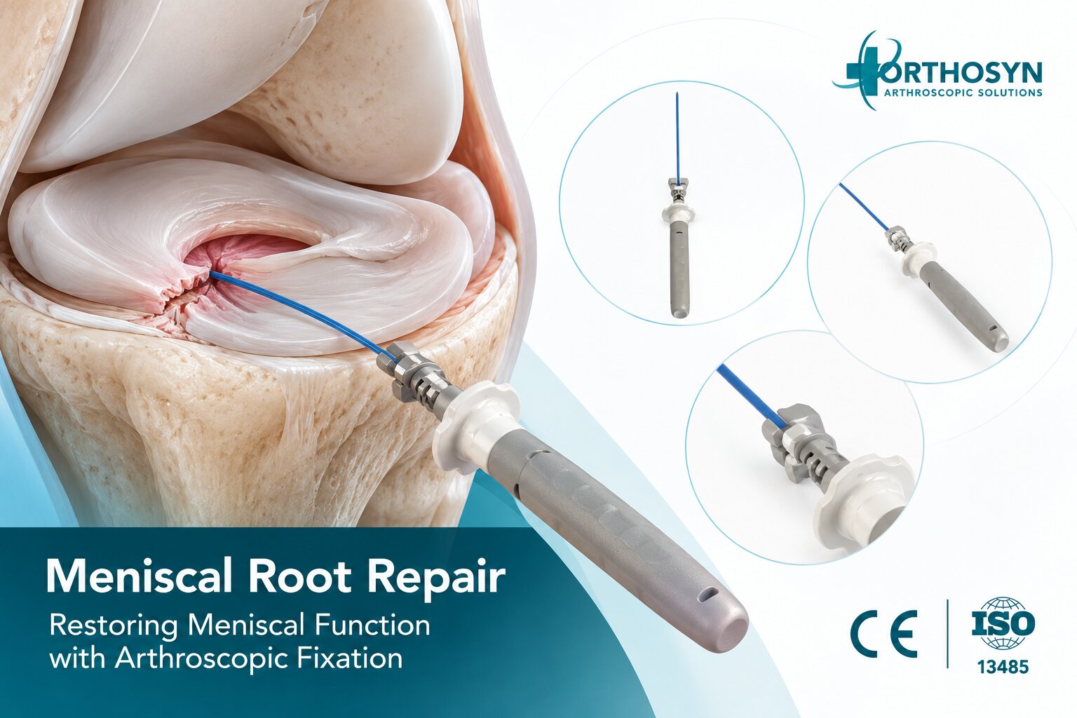 what-is-meniscal-root-repair-and-how-is-fixation-achieved