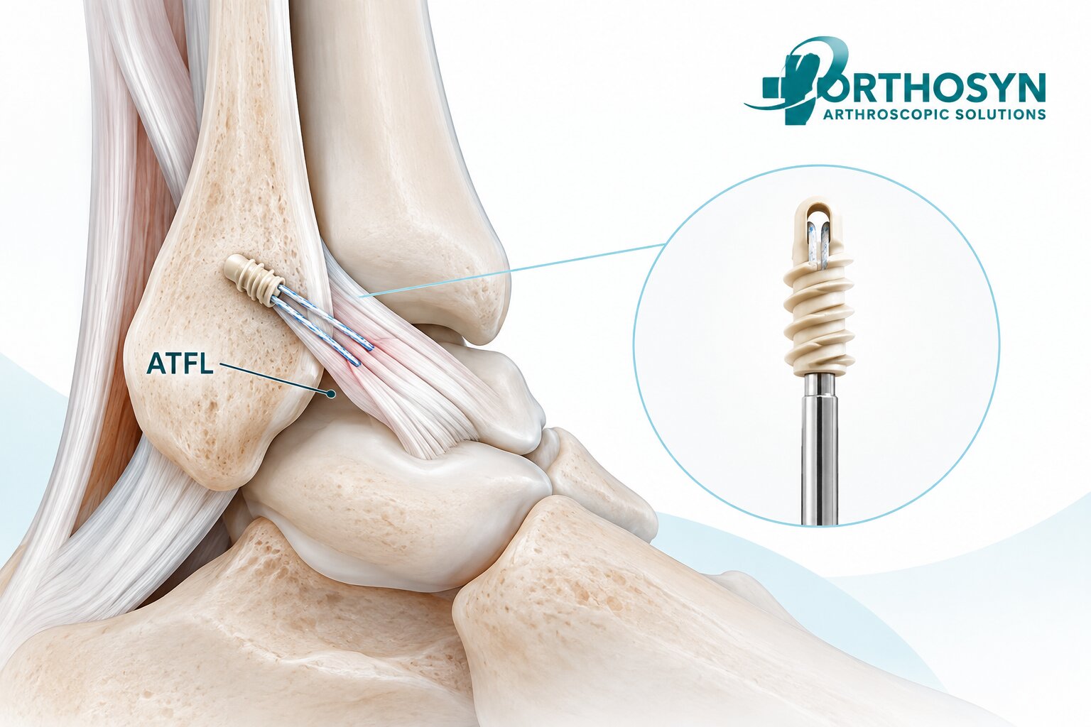 how-are-suture-anchors-used-in-atfl-repair